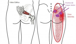 falsa ciatica 300x175