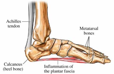 Fascitis Plantar