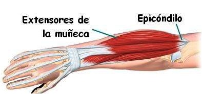 Epicondilitis